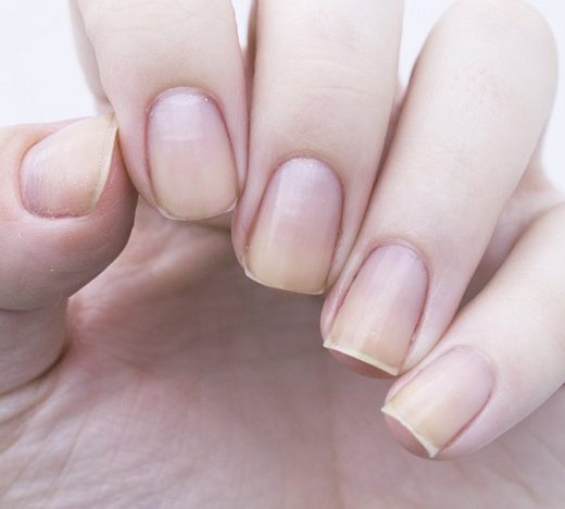 Beware of the detachment of the natural nail